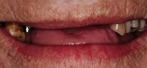 Antes: faltavam quase todos os dentes de cima