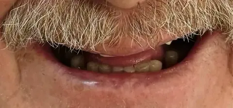 Antes: dentes perdidos e desgastados
