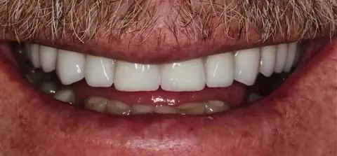 Depois: reabilitação com implantes