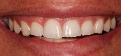 Antes: dentes com bordas irregulares