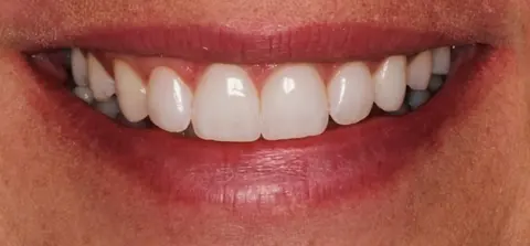 Depois: lentes de contato dental