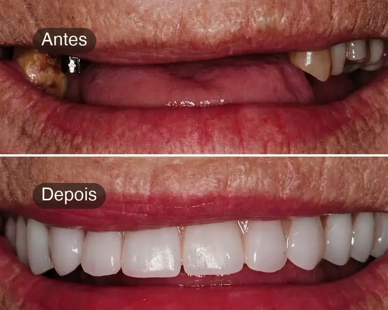 Antes e depois de paciente que recebeu dentes fixos sobre implantes