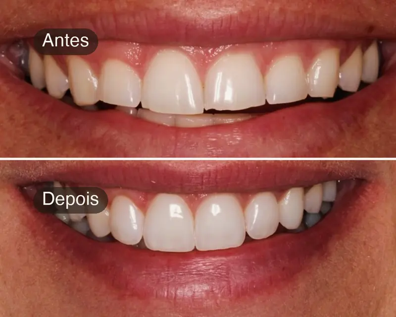 Antes e depois de sorriso com lentes de contato dental