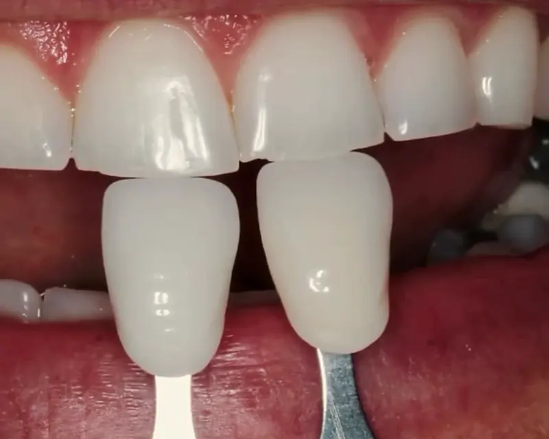 Escala de cor encostada nos dentes para escolher o tom do clareamento