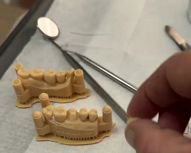 Modelo dos dentes impresso em 3D com a coroa de porcelana sendo encaixada